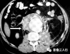 “卵壳状钙化征” 的影像表现与临床意义 “卵壳状钙化征” 的影像表现与临床意义