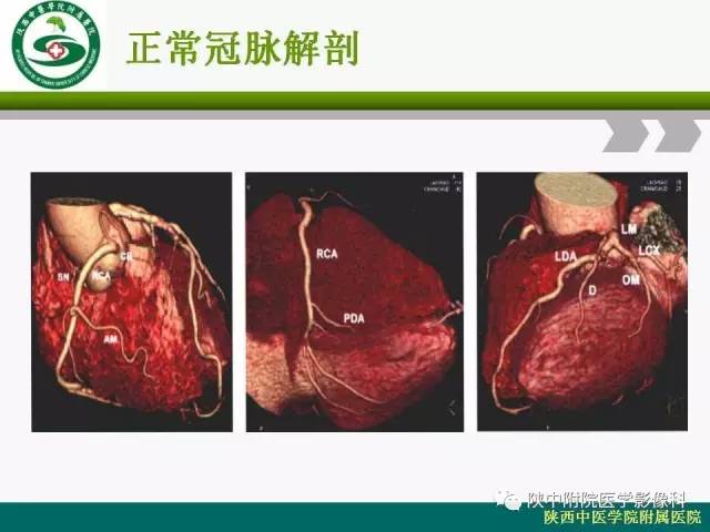 【PPT】冠状动脉、静脉正常解剖与变异