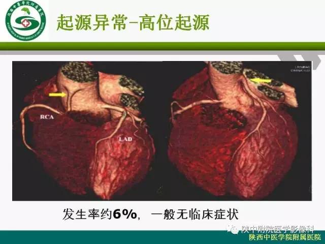 【PPT】冠状动脉、静脉正常解剖与变异