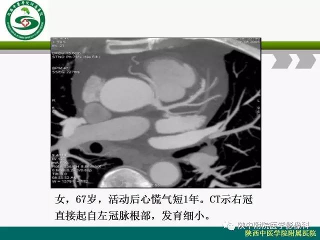 【PPT】冠状动脉、静脉正常解剖与变异