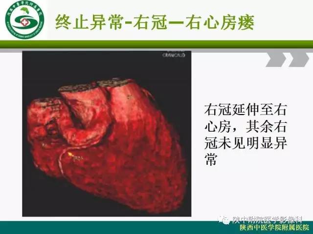 【PPT】冠状动脉、静脉正常解剖与变异