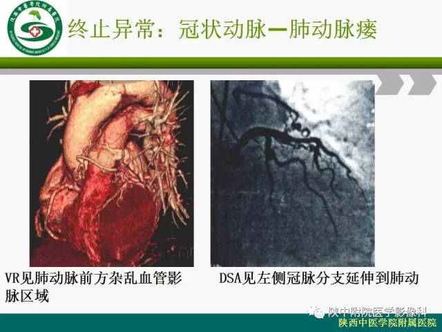【PPT】冠状动脉、静脉正常解剖与变异