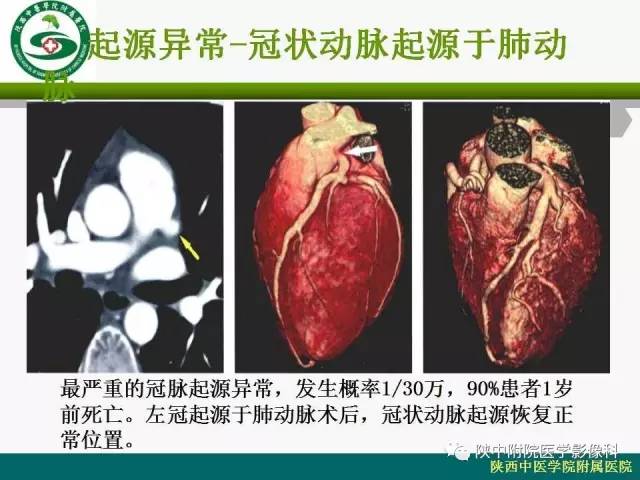 【PPT】冠状动脉、静脉正常解剖与变异
