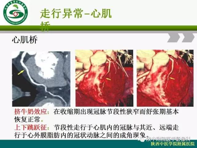 【PPT】冠状动脉、静脉正常解剖与变异