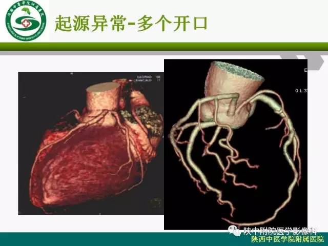 【PPT】冠状动脉、静脉正常解剖与变异