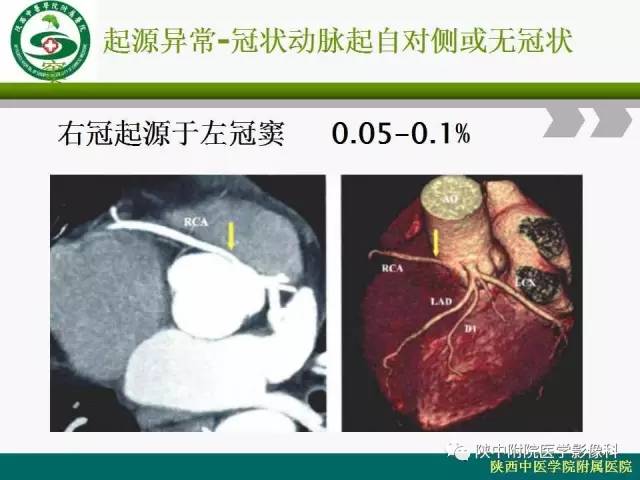 【PPT】冠状动脉、静脉正常解剖与变异