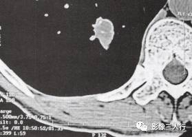 “锯齿征” 的影像表现与临床意义