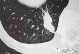 “锯齿征” 的影像表现与临床意义
