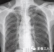“横膈连续征” 的影像表现与临床意义
