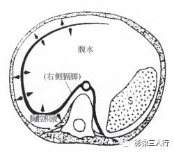 “横膈连续征” 的影像表现与临床意义