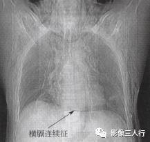 “横膈连续征” 的影像表现与临床意义