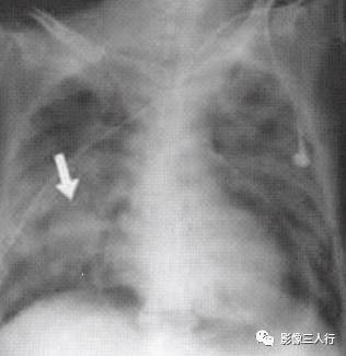 “横膈连续征” 的影像表现与临床意义