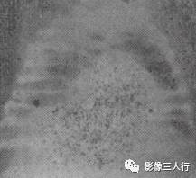 “横膈连续征” 的影像表现与临床意义