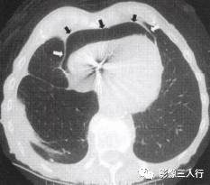 “横膈连续征” 的影像表现与临床意义