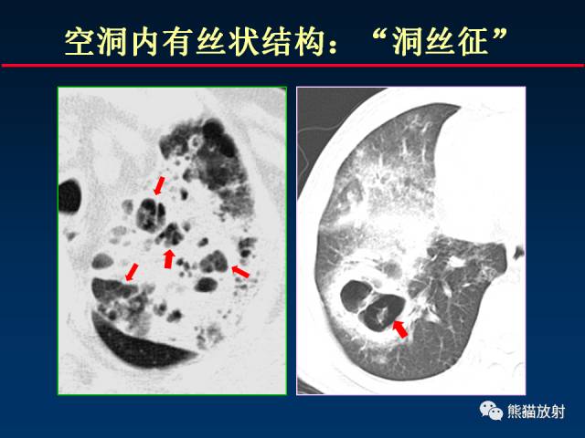 【PPT】肺曲霉菌病：放射科医生如何应对