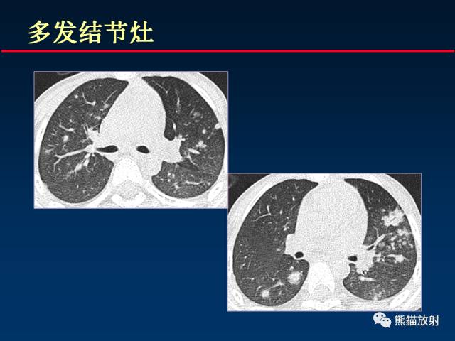 【PPT】肺曲霉菌病：放射科医生如何应对