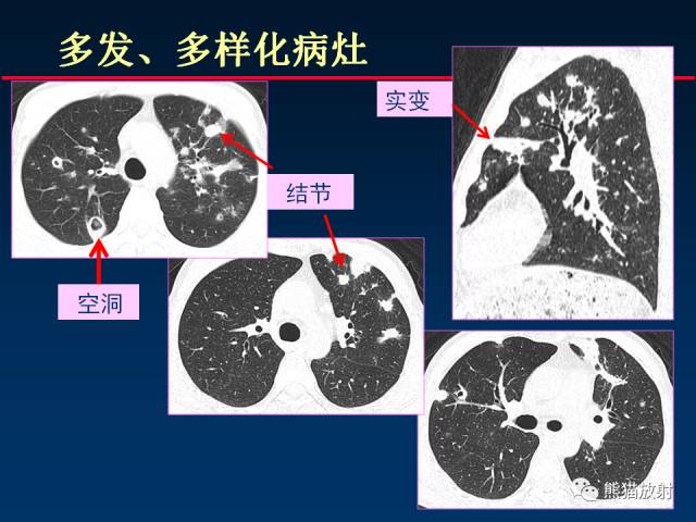 【PPT】肺曲霉菌病：放射科医生如何应对