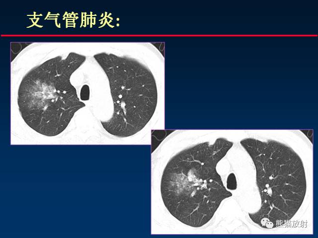 【PPT】肺曲霉菌病：放射科医生如何应对