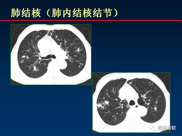 【PPT】肺曲霉菌病：放射科医生如何应对