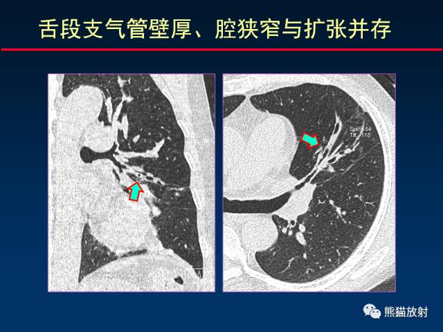 【PPT】肺曲霉菌病：放射科医生如何应对