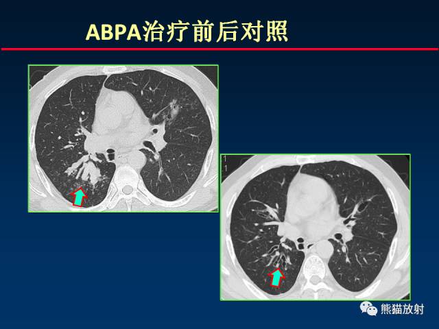 【PPT】肺曲霉菌病：放射科医生如何应对