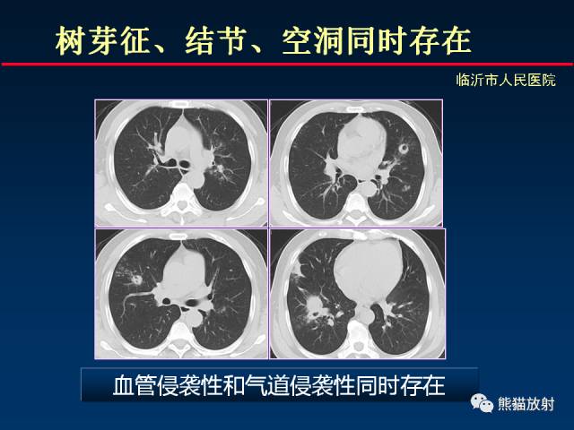 【PPT】肺曲霉菌病：放射科医生如何应对