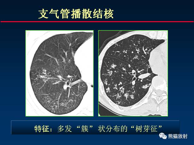 【PPT】肺曲霉菌病：放射科医生如何应对