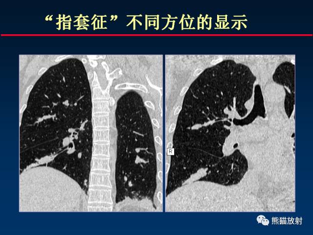 【PPT】肺曲霉菌病：放射科医生如何应对