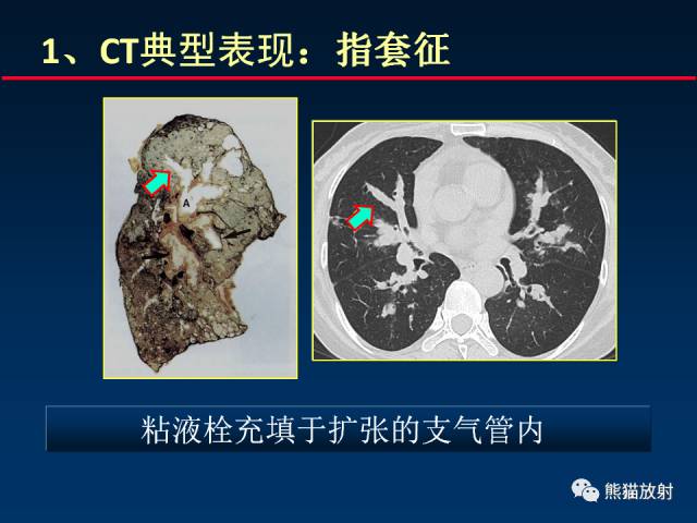 【PPT】肺曲霉菌病：放射科医生如何应对