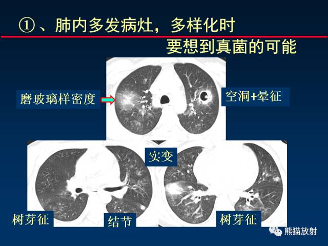 【PPT】肺曲霉菌病：放射科医生如何应对