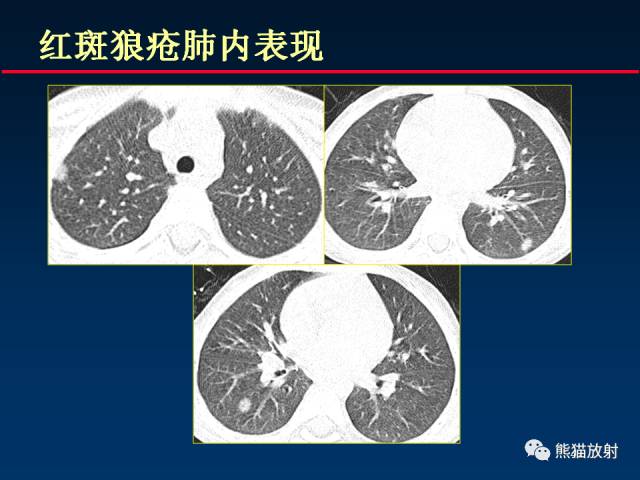 【PPT】肺曲霉菌病：放射科医生如何应对