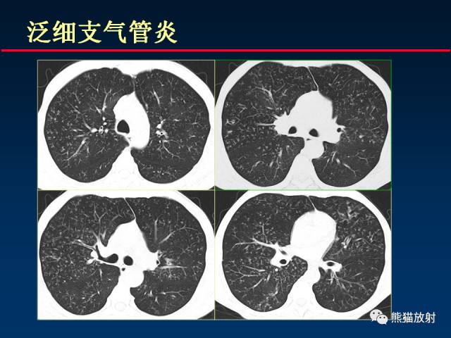 【PPT】肺曲霉菌病：放射科医生如何应对