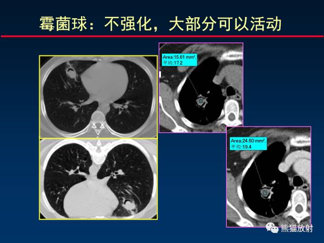 【PPT】肺曲霉菌病：放射科医生如何应对