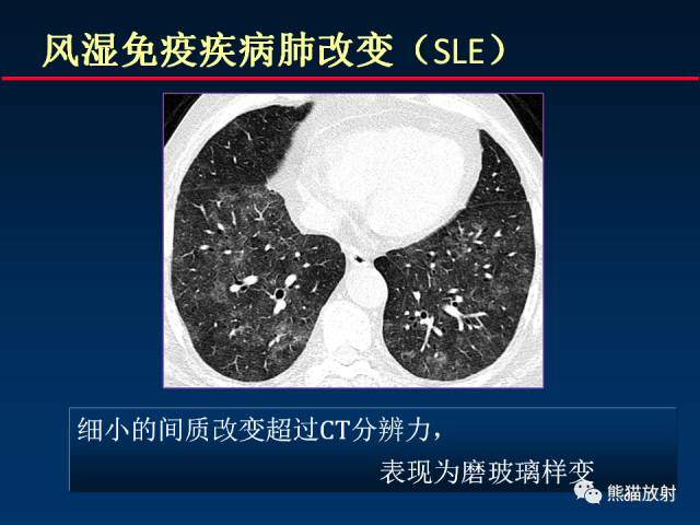 【PPT】肺曲霉菌病：放射科医生如何应对