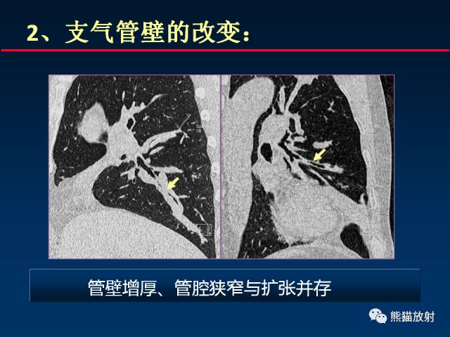 【PPT】肺曲霉菌病：放射科医生如何应对