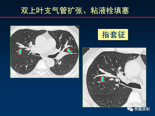 【PPT】肺曲霉菌病：放射科医生如何应对