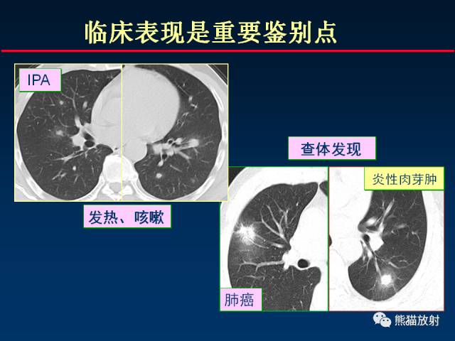 【PPT】肺曲霉菌病：放射科医生如何应对