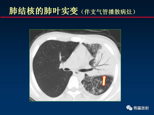 【PPT】肺曲霉菌病：放射科医生如何应对