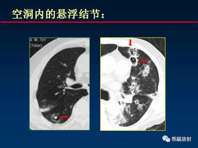 【PPT】肺曲霉菌病：放射科医生如何应对