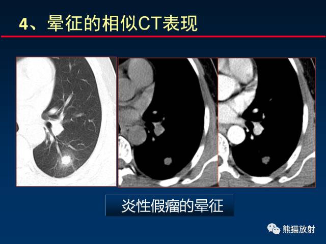 【PPT】肺曲霉菌病：放射科医生如何应对