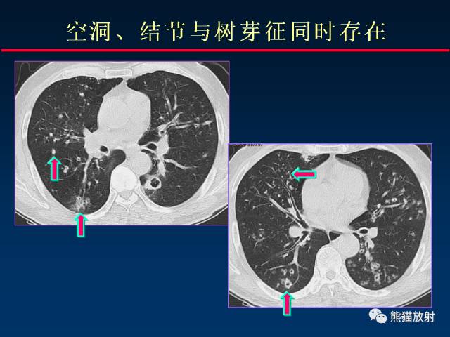 【PPT】肺曲霉菌病：放射科医生如何应对