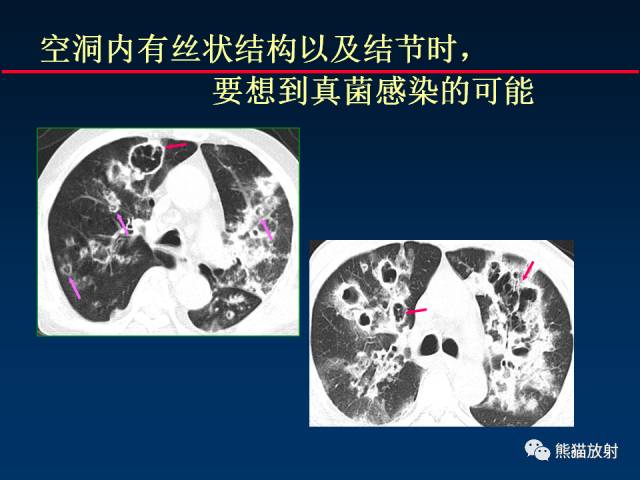【PPT】肺曲霉菌病：放射科医生如何应对