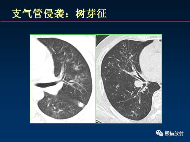 【PPT】肺曲霉菌病：放射科医生如何应对