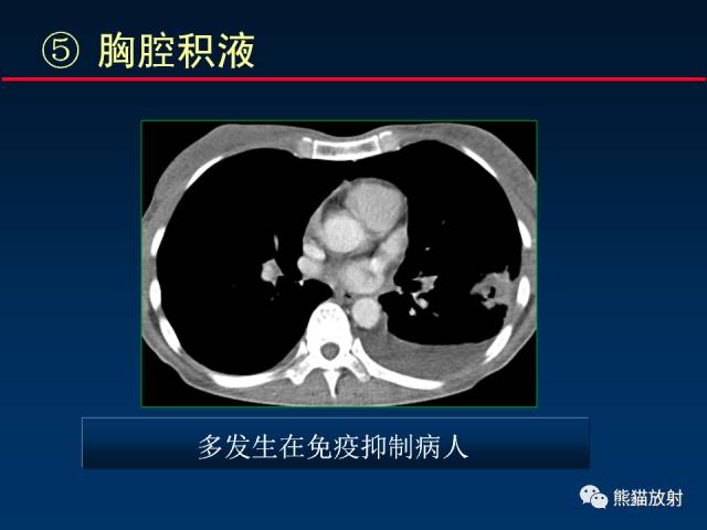 【PPT】肺曲霉菌病：放射科医生如何应对