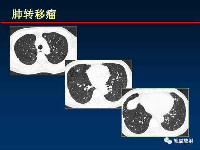 【PPT】肺曲霉菌病：放射科医生如何应对