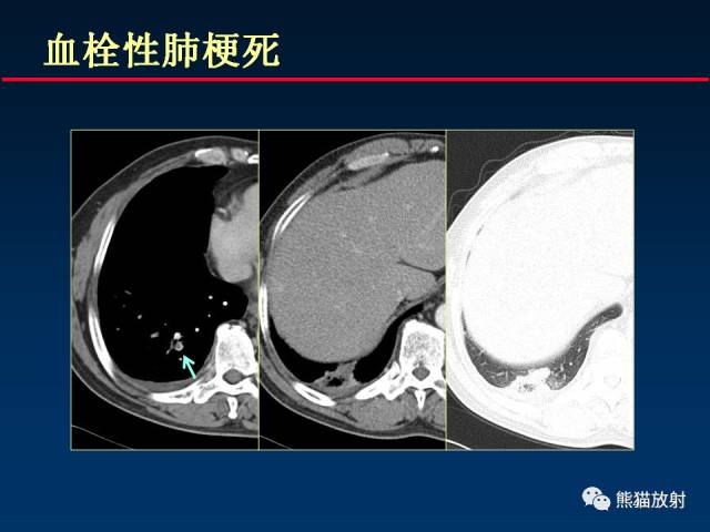 【PPT】肺曲霉菌病：放射科医生如何应对