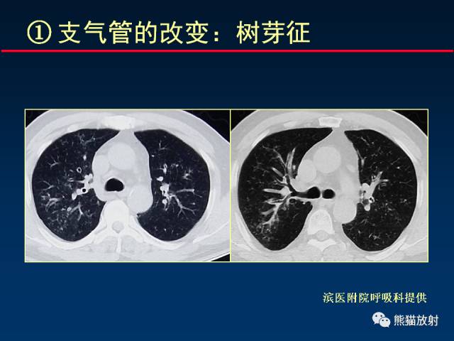 【PPT】肺曲霉菌病：放射科医生如何应对