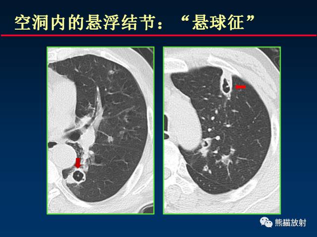 【PPT】肺曲霉菌病：放射科医生如何应对