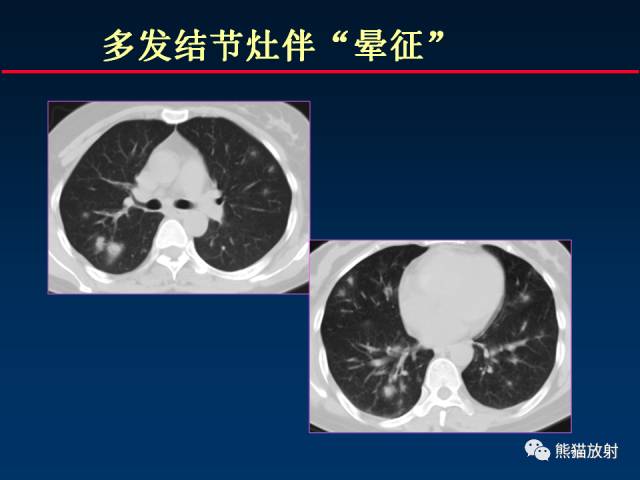 【PPT】肺曲霉菌病：放射科医生如何应对