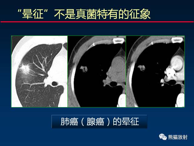 【PPT】肺曲霉菌病：放射科医生如何应对
